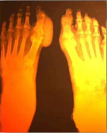 Current Gout Clinical Trials