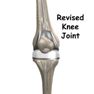 Knee Revision Surgery Delhi | Revision Knee Replacement India