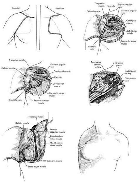 Fig 10A-3. Anterior technique of forequarter a | O&P Digital Resource Library | Oncology nursing ...