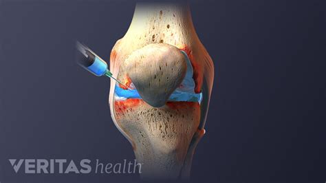 Hyaluronic Acid Injection for Knee Osteoarthritis: Procedure and Risks | Arthritis-health