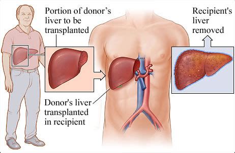 Best Liver Transplantation in India - Best Liver Transplant Hospital - Liver Transplant Surgery ...