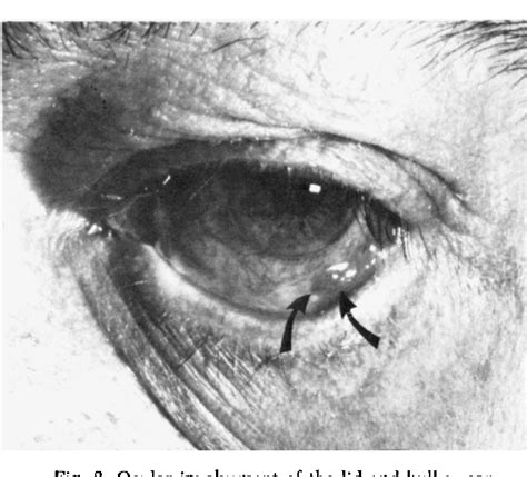 Figure 2 from Benign Mucous Membrane Pemphigoid | Semantic Scholar