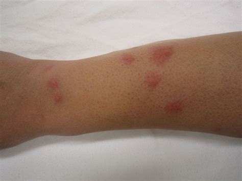 Bed Bugs Rash, Symptoms, Treatment (Edited)