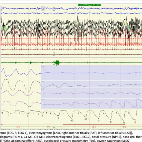 An obstructive hypopnea. A hypopnea is classified as an obstructive ...