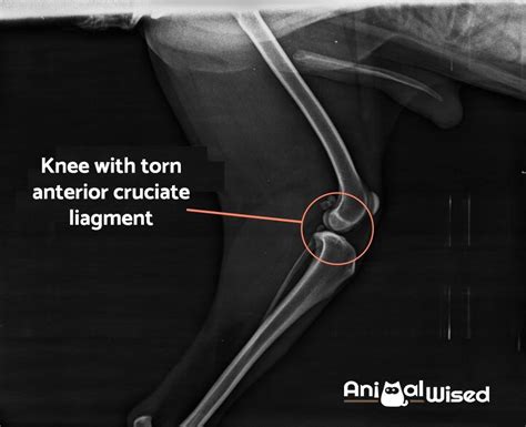 Anterior And Posterior Cruciate Ligament Injury