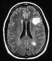 Multiple Sclerosis Center - HealthCare Journey for Multiple Sclerosis