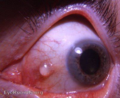 Inclusion Cysts Eyelid