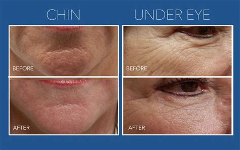 Micro-Needling with PRP Skin Rejuvenation Rochester, NY