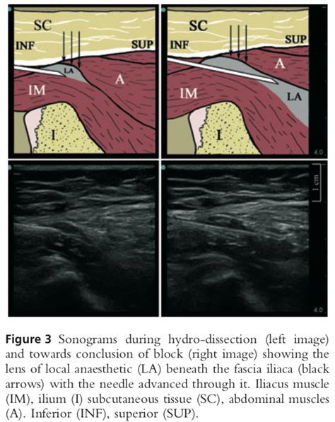 Ultrasound-guided supra-inguinal fascia iliaca block: a cadaveric evaluation of a novel approach ...