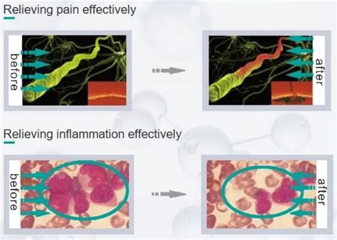 Physical Laser Therapy Device For Pain Relief – Suyzeko