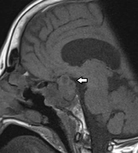 MRI pituitary without contrast showing a pituitary mass, initially... | Download Scientific Diagram