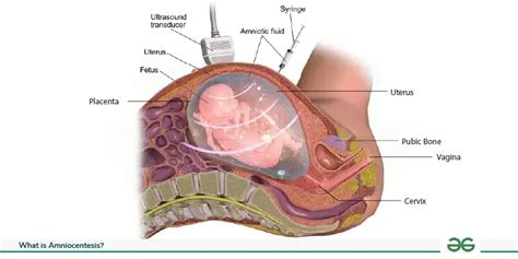 What is Amniocentesis Class 12? - Procedure and Complications - GeeksforGeeks