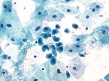 Atypical Urothelial Cells Indeterminate for Neoplasia - Urothelial Cells