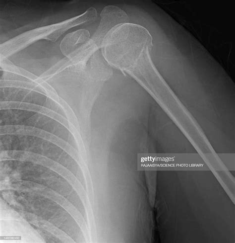 Humerus Fracture Xray High-Res Stock Photo - Getty Images