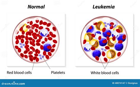 Leukemia Or Leukaemia Stock Vector - Image: 48074147