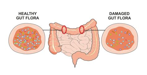 What Leads To Candida In The Stool? | IBS Gut Health Clinic