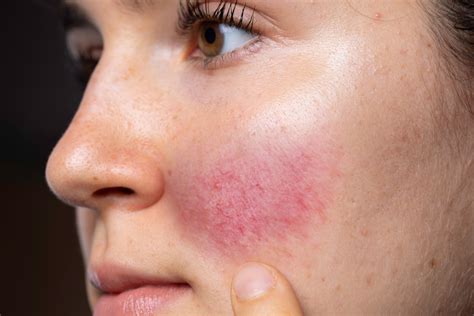 What Is Rosacea and How Is It Treated? - Mirabile