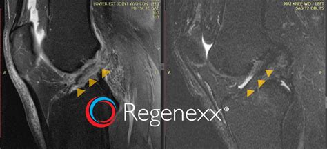 Can an ACL Stem Cell Shot Replace Surgery? - Regenexx Blog