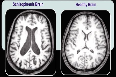 The mystery of schizophrenia - Livemint