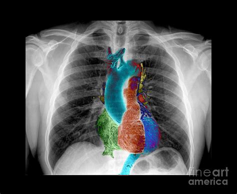 X-ray Of Chest And Heart Photograph by Living Art Enterprises - Fine ...