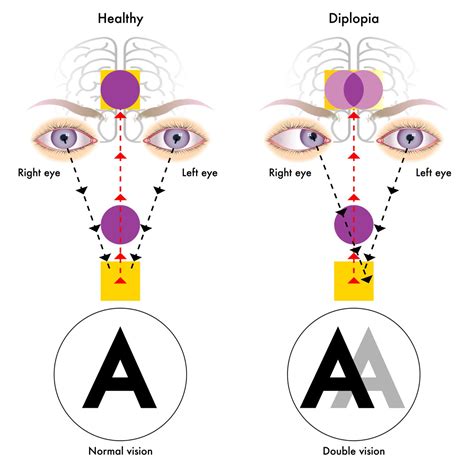 What is Double Vision? - Causes, Symptoms & Treatment