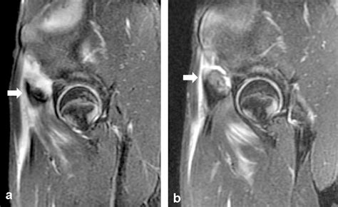 Current concepts in MRI of rectus femoris musculotendinous ...