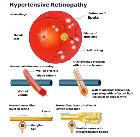 HYPERTENSIVE RETINOPATHY - Ishwar Eye Centre