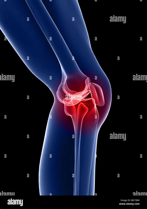 inflamed knee Stock Photo: 22168717 - Alamy