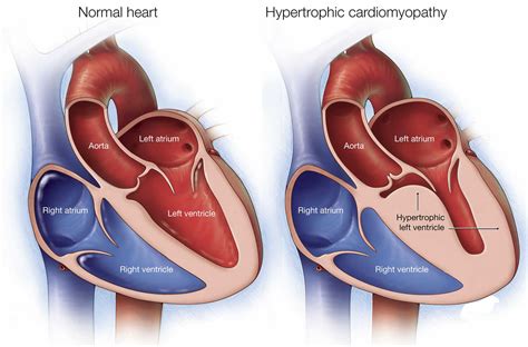 Asymmetric septal hypertrophy, definition, causes, symptoms, diagnosis, treatment & prognosis