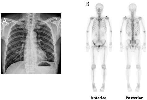 Metastatic prostate cancer initially presenting as chylothorax: A case report