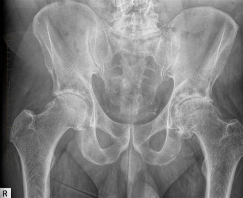 Osteoarthritis of the Hip