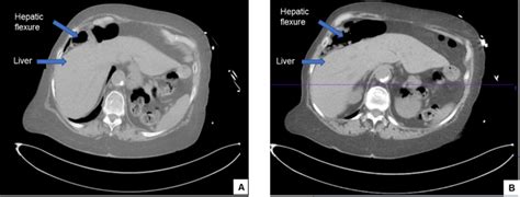 Cureus | Chilaiditi Syndrome: A Rare Case of Chest Pain due to Colonic ...