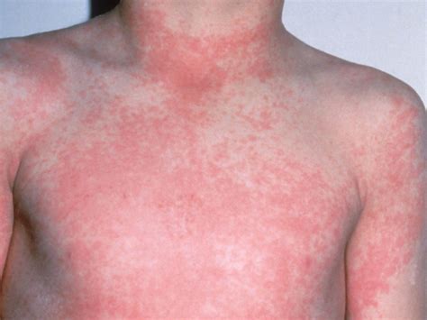 Prevent infestation with Scarlet Fever, reduce the risk of having ...