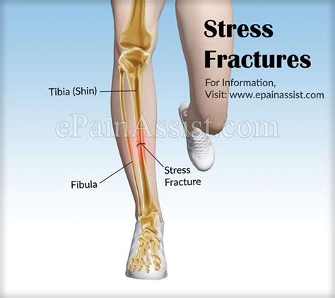 Stress Fractures | Stress fracture, Stress fracture shin, Stress