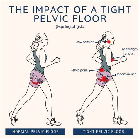 Tight Pelvic Floor – Telegraph