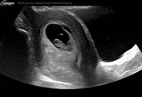 My 8 week ultrasound! Does this look normal? | BabyCenter