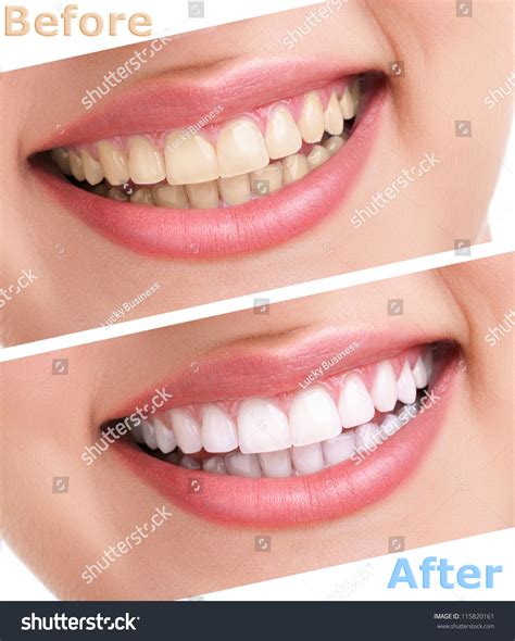 Bleaching Teeth Treatment , Close Up, Isolated On White, Before And ...