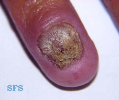 Chronic mucocutaneous candidiasis - wikidoc