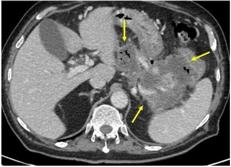 Successful Treatment of Pancreatic Pseudocysto-Duodenum Fistula with Ultrasound Endoscopic ...