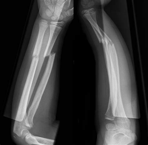 Fractures - Forearm