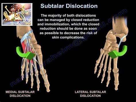 Subtalar Dislocation – Dr. Nabil Ebraheim's Blog