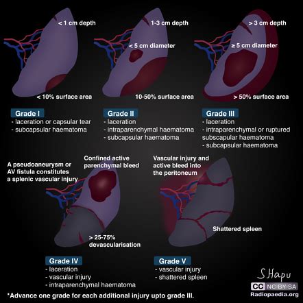 Splenic trauma | Radiology Reference Article | Radiopaedia.org