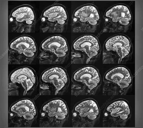 Alzheimer's disease, MRI brain scans - Stock Image - C038/8649 ...