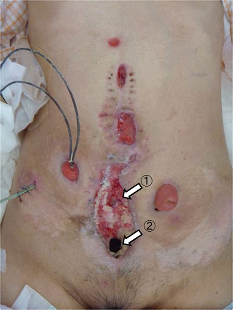 Abdominal wound. The ruptured colon at the center of the abdominal ...