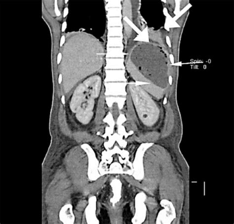 CT scan of the abdomen showing splenic abscess (thin wh | Open-i