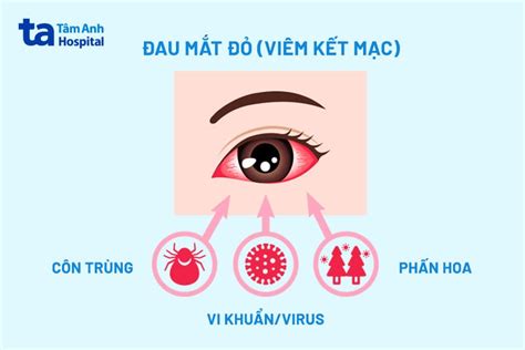 Bị đau mắt đỏ 1 bên nhưng không đau có sao không? Bao lâu thì khỏi?