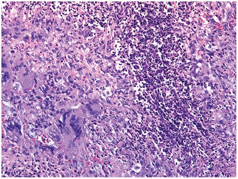 Histological section of a granulomatous lesion in the lung of a... | Download Scientific Diagram