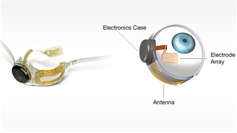 Age-related macular degeneration patient receives bionic eye transplant