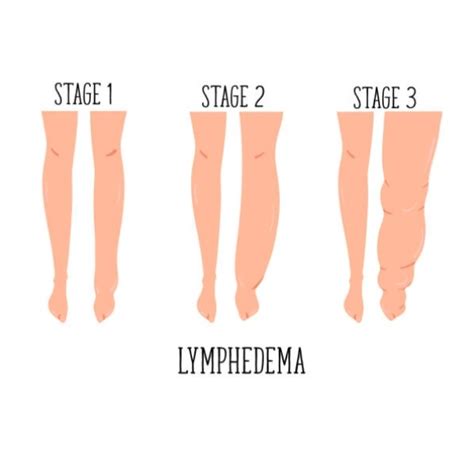 Lymphedema Therapy Plano, TX | Lymphedema Therapist Dallas