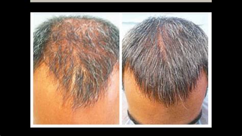 Nizoral Hair Loss Shampoo Treatment and its Effectiveness